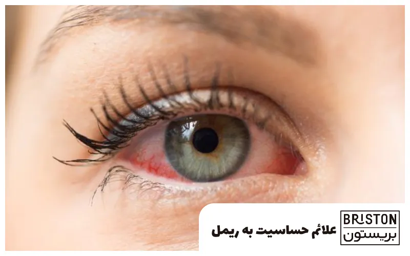 علائم حساسیت به ریمل